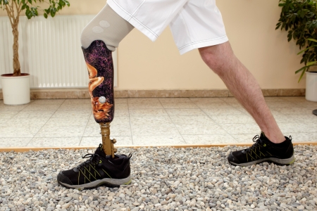 Amputation Injuries in West Virginia