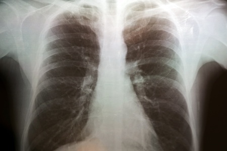 Asbestos and Mesothelioma Deaths: Still a Public Health Concern