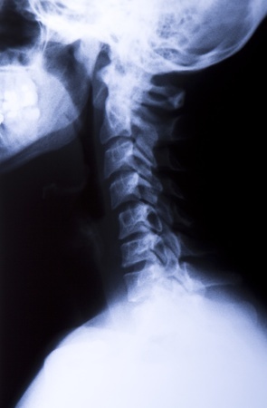 Identifying and Understanding Your Whiplash Injury