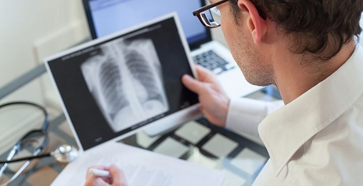 Asbestos Caused Mesothelioma Lung X-Ray