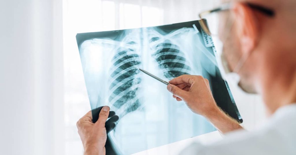 male doctor reviewing chest X-ray of patient with lung disease